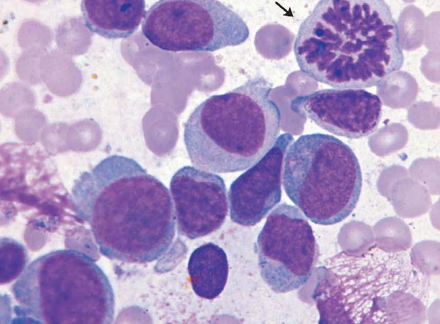 急性粒-单核细胞白血病-M4a型